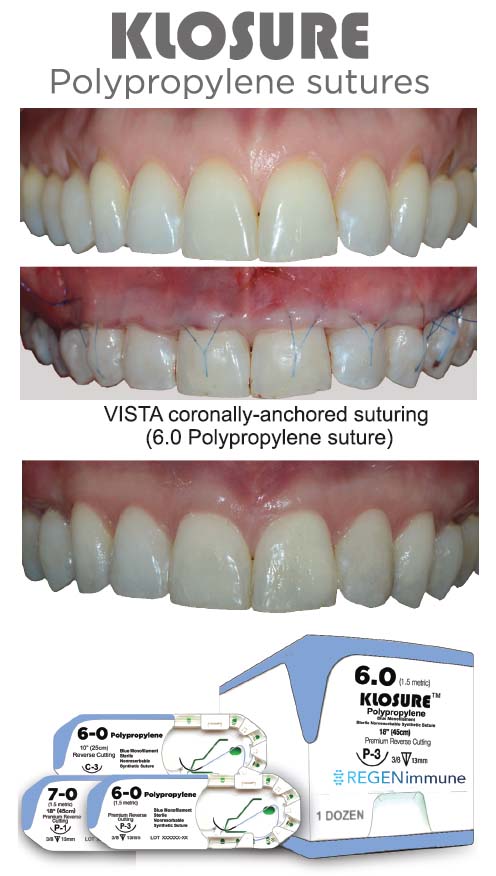 Klosure Polypropylene Suture