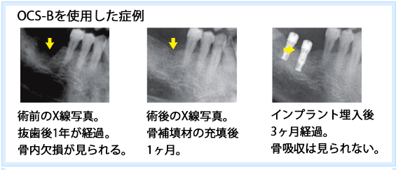 OCS-B 症例写真1