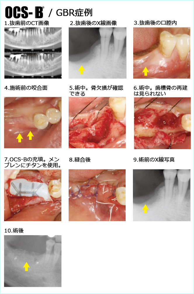 OCB-B 症例写真4